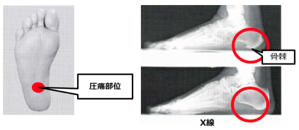 足底腱膜炎 圧痛・X線・超音波検査・MRI検査