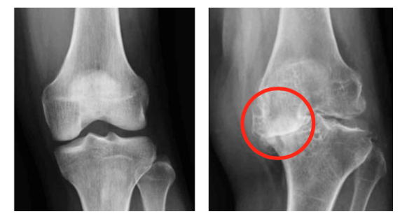 変形性膝関節症 診断