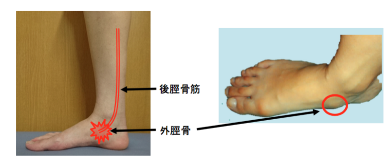 有 痛 性 外 脛骨 障害