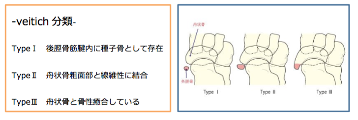 痛 外 脛骨 性 障害 有 有痛性外脛骨を自分で治す方法｜たかはし鍼灸接骨院｜note