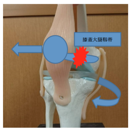 膝蓋骨脱臼の原因