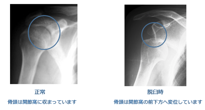 反復性肩関節脱臼 り整形外科クリニック 公式 神戸市東灘区 スポーツ整形外科