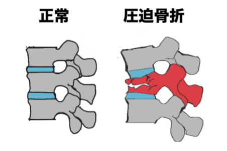 第 三 腰椎 圧迫 骨折