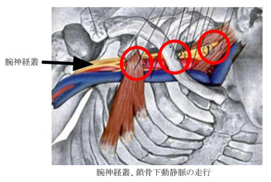 症候群 胸郭 出口 鎖骨の下を押すと痛みがでる『胸郭出口症候群』とは！？症状と「3つ検査方法」を詳しく解説