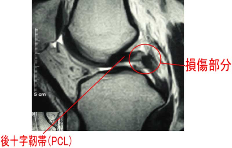 後十字靭帯損傷 こうじゅうじじんたいそんしょう り整形外科クリニック 公式 神戸市東灘区 スポーツ整形外科